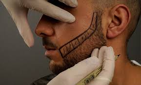 A close-up of a man undergoing a beard transplant procedure, with surgical markings drawn on his face to outline the desired beard shape. A medical professional wearing gloves is using a marker to finalize the transplant design.